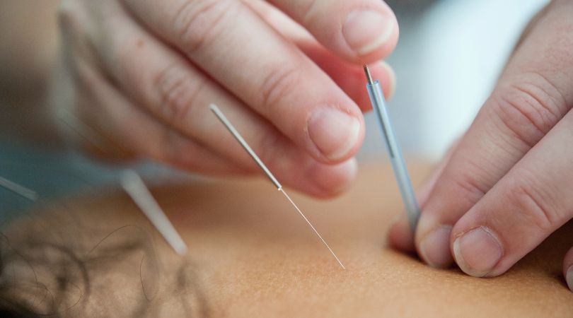 5 Ways Acupuncture Can Help Reduce Stress